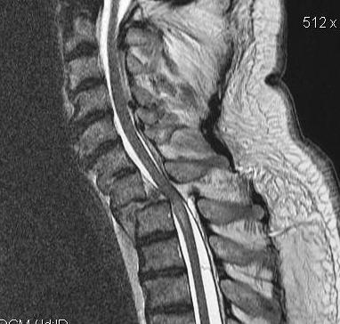 Spine T2 MRI